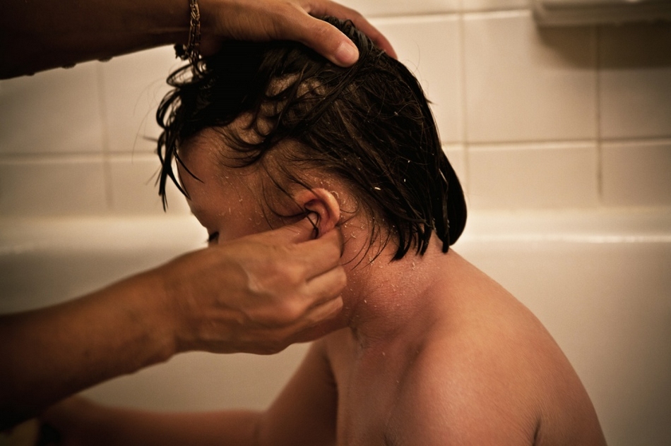 孤兒?。呼~鱗病女孩的艱難生活【圖】