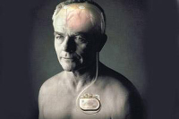 【健康解碼】起搏器真的能治好帕金森病嗎？